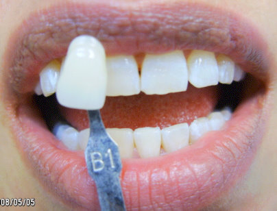 Image of a patient after whitening