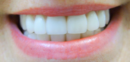 Image of new dentures