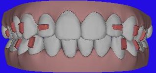 Picture after Invisalign