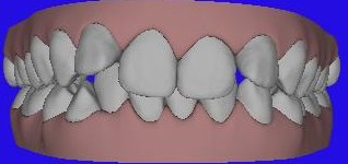 Invisalign Maxillary Before