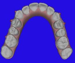 Picture after Invisalign
