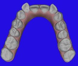Invisalign Maxillary Before