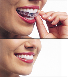 Removable braces